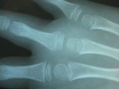 broken-finger